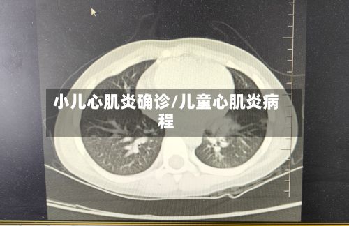 小儿心肌炎确诊/儿童心肌炎病程